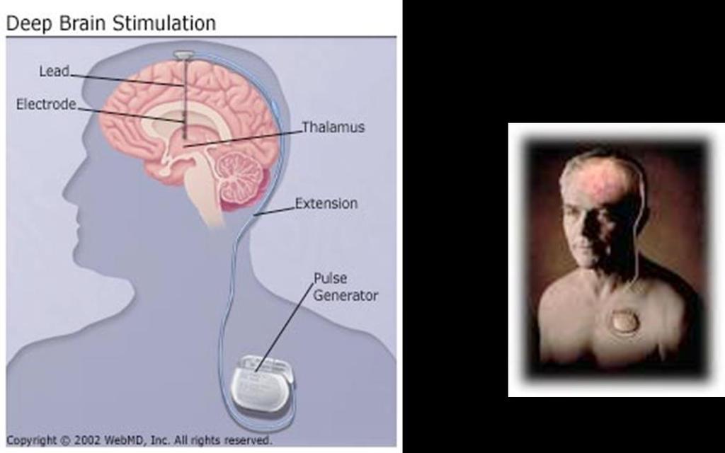 Spodbujanje možganov (Deep Brain Stimulation (DBS)) Kirurška procedura, ki se uporablja pri blaženju simptomov