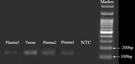 مجله دانشگاه علوم پزشکی بابل دوره بیستم/ شماره 4/ فروردین 3179 مقایسه سطح پالسمایی RNA طویل غیرکدکننده.