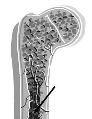 Šta je mijelom? Mijelom, takođe poznat kao multipli mijelom, je maligna bolest koštane srži koji nastaje od najzrelijih limfocita tzv. plazmocita koji se i inače nalaze normalno u koštanoj srži.