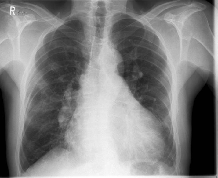 Eisenmenger i sündroom ja pulmonaalhüpertensioon vs.