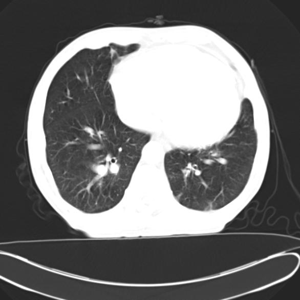 Eisenmenger i sündroom ja pulmonaalhüpertensioon vs.