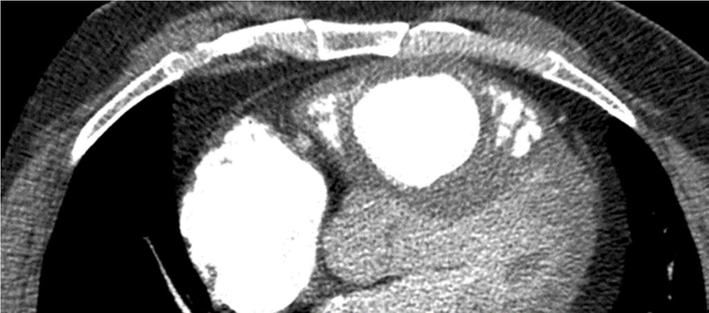 CTEPH CT uuringul Arterite