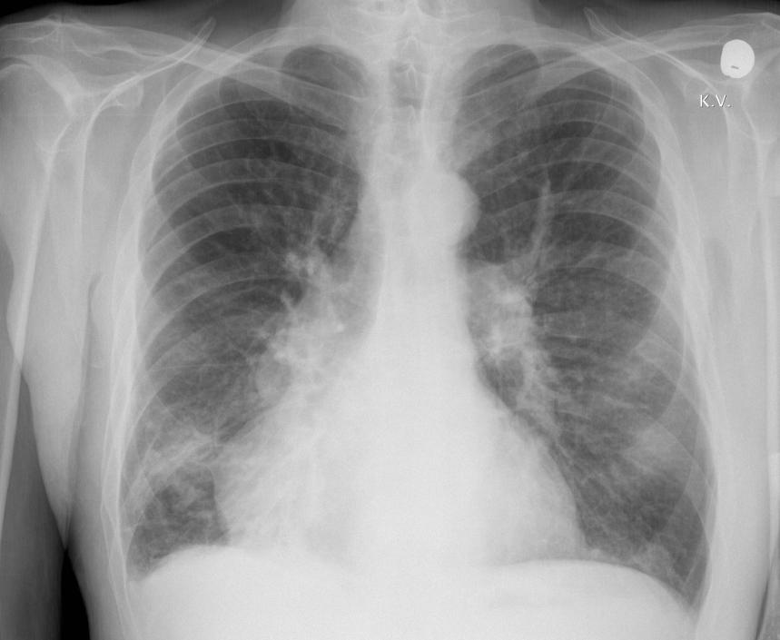 Rindkere röntgenogramm pulmonaalhüpertensiooni korral Patoloogiline leid 90%-l diagnoosimise hetkel Kopsuarterite tsentraalse osa dilatatsioon perifeeria äralangemisega Kaugelearenenud juhtudel