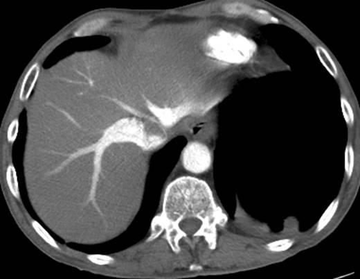 CT-angiograafia leid: parema südamepoole puudulikkuse tunnused Parem vatsake