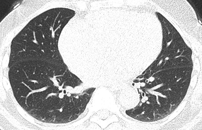 kollateraaltsirkulatsioonile Peened, keerdus arterid, algavad