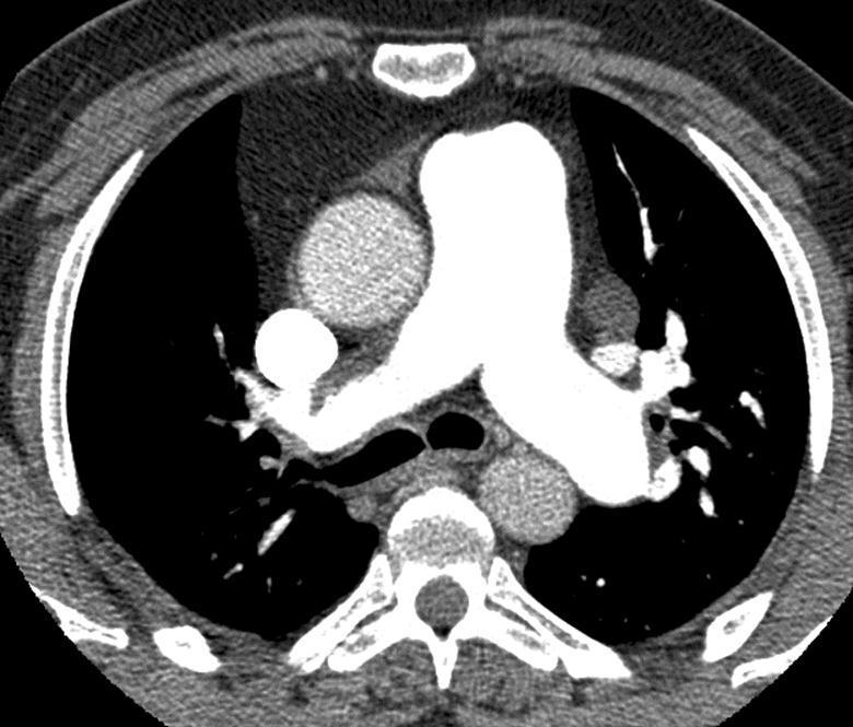 Pulmonaalhüpertensiooni tunnused CT