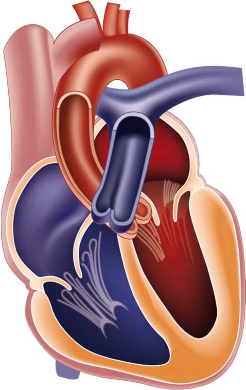 EhhoKG pulmonaalhüpertensiooni korral, pulmonaalrõhu arvutamine