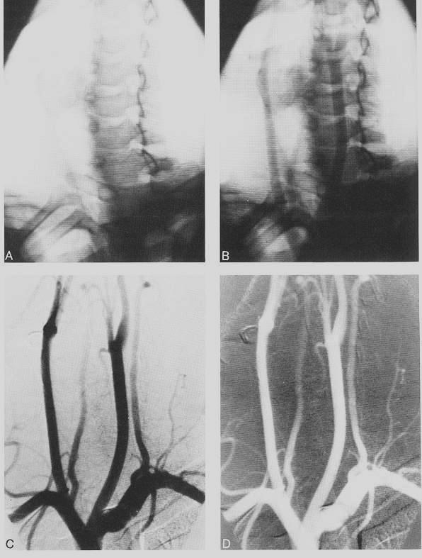 DIGITAALNE SUBTRAKTSIOON ANGIOGRAAFIA