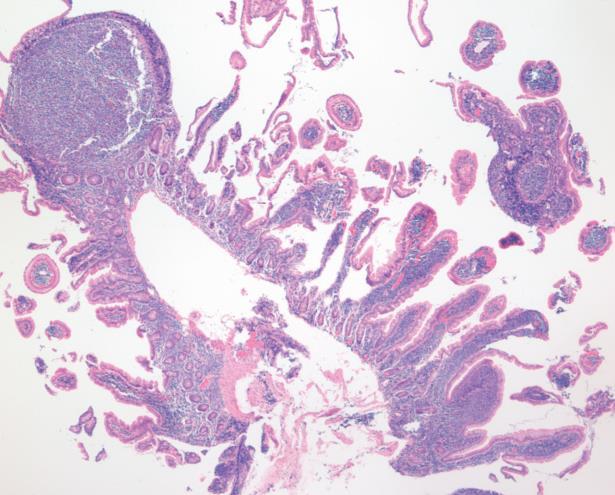 duodenálny FL - lokalizované ochorenie duodenum, jejunum,