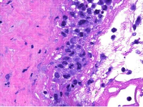 ALCL ) - CD30+, ALK-negat.