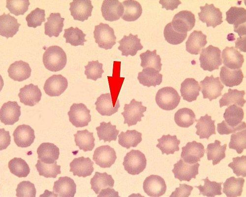 Deficienţă congenitală (AR) care conduce la anemie hemolitică cronică numărul eritrocitelor datorită scăderii aportului energetic; eritrocitele nu îşi menţin integritatea peretelui celular datorită