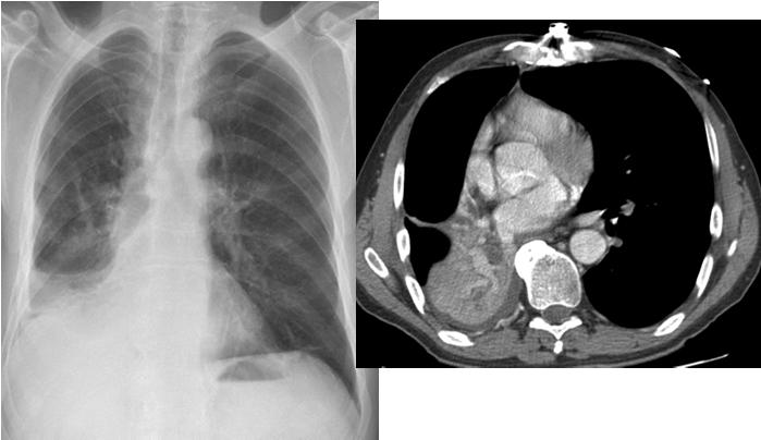 atelektaasi põhjus Primaarkasvajast tingitud sümptomid I Köha ja intrapulmonaalne striidor tsentraalse kopsukasvaja korral Striidor e.