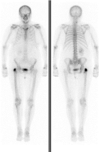 - luumetastaas Eest Tagant Kopsuvähi sümptomid intratorakaalsest levikust Närvisüsteemi osade haaratus N. laryngeus recurrens i halvatus: 2 18% N.