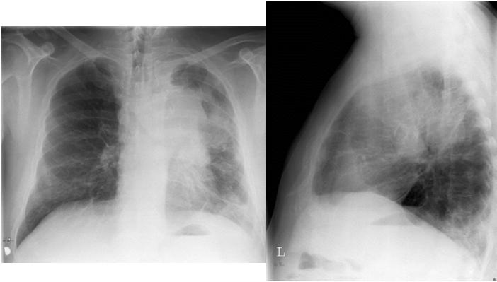 Muud paraneoplastilised sündroomid kopsuvähi korral Skeletisündroomid Hüpertroofiline osteoartropaatia (HOA): kuni 4%-l juhtudest Sümmeetrilise hüppe-, põlve-, randme- või küünarliigeste artropaatia