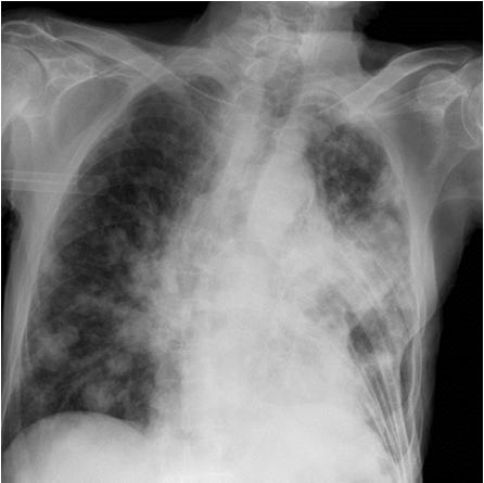 Röntgenleiu variandid kopsuvähi korral Varjustus tipus (pancoast-tüüpi) Perifeerne (solitaarne) ümarvari Destruktsioon (kavitatsioon) kopsus Perifeerne bronhioloalveolaarne (halvasti piirdunud