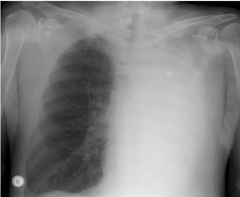 osalisest bronhisulgusest) Halvasti paranev pneumoonia Bronhiektaasid Obstruktiiv-atelektaatiline pneumoniit (tuumori suhtes perifeerne varjustus koos haaratud kopsuosa mahu osalise vähenemisega) ja