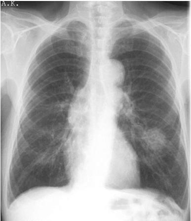 kopsus Suur lisamass keskseinandi vasakul lateraalkontuuril Bronhoskoopial kindlat endobronhiaalset kasvajat ei näe Vasakul intersegmentaarsed kariinid lamenenud, sealt biopsia + haritsütoloogia