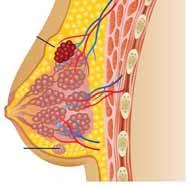 vrhnjice, ki obdaja lobule režnjiče (mešičke, kjer nastaja mleko), pa je to lobularni karcinom rak.