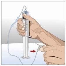7. Pregătiţi setul cu ac cu hialuronidază umană recombinantă (HY): Ataşaţi seringa umplută cu hialuronidază umană recombinantă la setul cu ac Împingeţi pistonul seringii mai mici pentru a scoate
