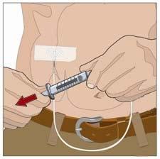 Evitaţi regiunile cu proeminenţe osoase, vasele de sânge vizibile, cicatricele şi regiunile cu inflamaţie sau infecţie.