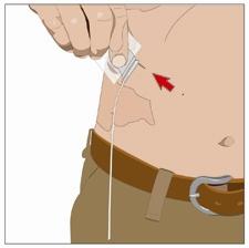15. Administraţi imunoglobulina umană normală 10%: După perfuzarea întregului conţinut al seringii mai mici (hialuronidaza umană recombinantă), scoateţi seringa din conectorul setului cu ac.