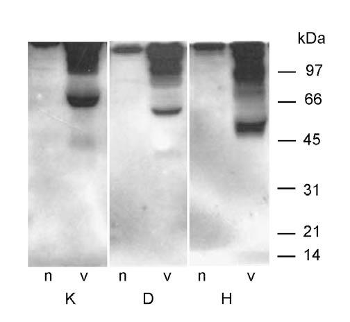 4.4.1 Ispitivanje formi IGFBP-1 metal-afinitetnom hromatografijom kod zdravih osoba i pacijenata sa DM2 ili hipoglikemijom Serumi pacijenata sa DM2 ili hipoglikemijom, kao i kontrolni serumi