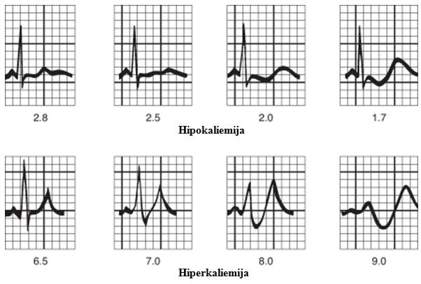 UVOD 1.6.2.3. KLINIČNA SLIKA Hipokaliemija povzroči motnje v delovanju srca. V EKG se pojavi značilen val U, spojnica ST in val T sta nižje, prihaja do motenj ritma in prevajanja (slika 8).