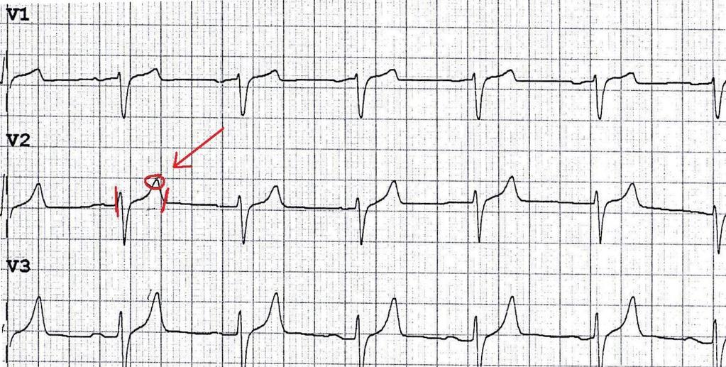 Urška Polanc Diplomska naloga RAZPRAVA hiperkaliemije pojavil nodalni ritem. V dveh primerih EKG ni bil priložen. Hiperkaliemijo so zdravili v treh primerih. Štiri primeri so se končali s smrtjo.