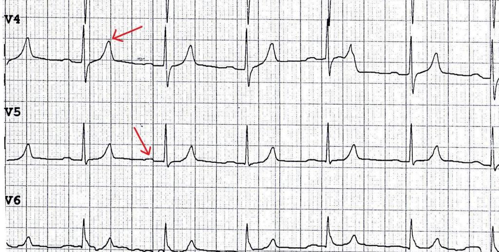 Vzrok hiperkaliemije naj bi bila akutna ledvična odpoved zaradi dehidracije. Na EKG posnetku (slika 13) opazimo visoke zašiljene T vrhove in krajši QT interval.