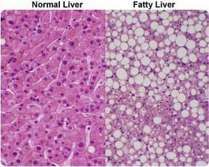 Gastrointestinalni zapleti Maščobna infiltracija jeter: 38% debelih otrok/mladostnikov vs. 5% normalno prehranjenih ima t.i. zamaščena jetra (angl.
