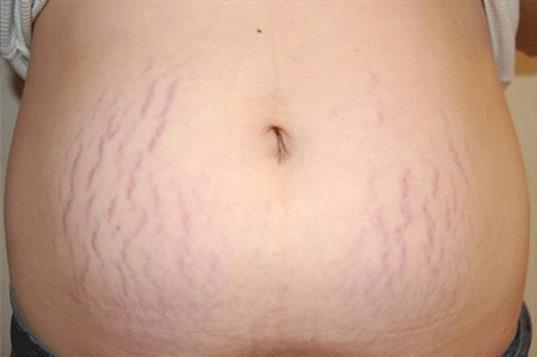 dermatitis v predelu pregibov.
