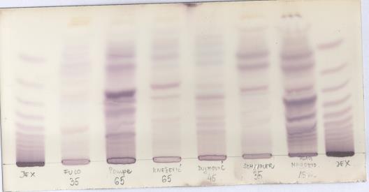 DIJAGNOZA -glukozidaza - limfociti - FIBROBLASTI- bioptat kože