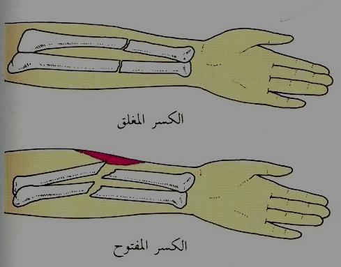 شكل )4(: الكسر المغلق والكسر المفتوح عن www. Shamoa.