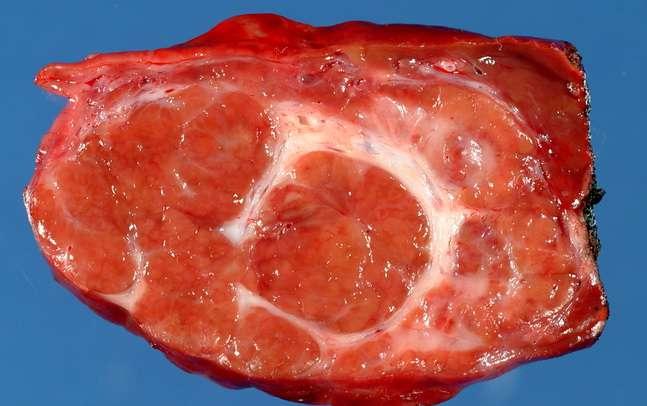 Slika 3.1.3. fokalna nodularna hiperfazija (www.humpath.com ) 3.2. Maligni tumori jetre 3.2.1. Hepatocelularni karcinom Hepatocelularni karcinom je najčešći primarni maligni tumor jetre (Slika 14).