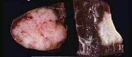 3.2.2. Kolangiokarcinom Primarni je zloćudni tumor koji potječe od epitela intrahepatičnih žučnih vodova (Slika 15).