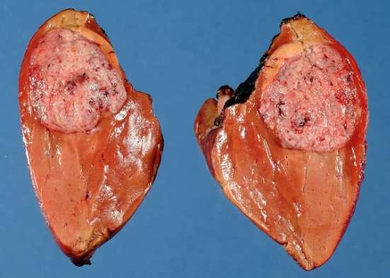 Slika 3.2.3. Hepatoblastom (www.humpath.com ) 3.2.4. Angiosarkom Rijedak maligni mezenhimalni tumor jetre, potječe od stanica koje oblažu jetrene sinusoide (Slika 17).