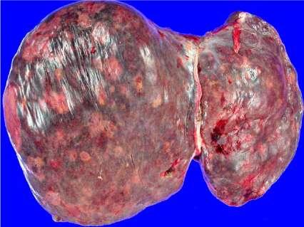 Slika 3.2.4. Angiosarkom (www.synapse.koreamed.org ) 3.3. Klinička slika osoba s karcinomom jetre Kod osoba sa razvojem tumora jetre primjećen je izrazit gubitak tjelesne težine, gubitak teka, mučnina, opstipacija i povračanje.