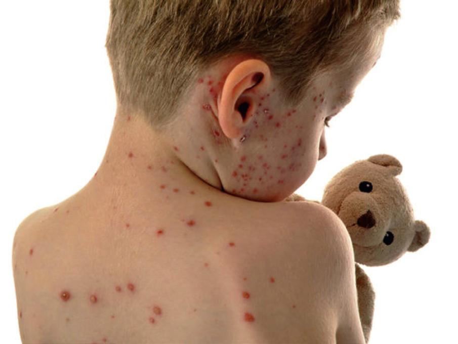 Vėjaraupių epidemiologijos, klinikos ir profilaktikos metodinės rekomendacijos susidaro pūslelė su skaidriu skysčiu, kuriai džiūvant, susidaro šašas.