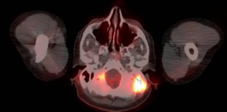 Ekstrapulmonaalne sarkoidoos 18 FDG PET-CT uuring: oluline aktiivsus