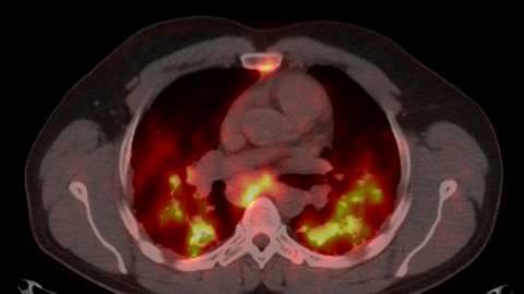 Kopsude sarkoidoos: 18 FDG PET-CT uuring 18 FDG