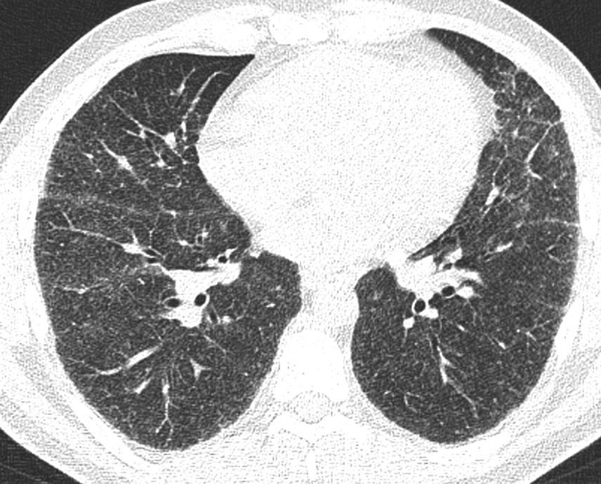 II staadiumi sarkoidoosi HRCT leid Sama 38-aastane meespatsient, II staadiumi leid,