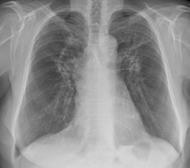 IV staadiumi sarkoidoos 69-aaastane naispatsient Fibrootiline staadium