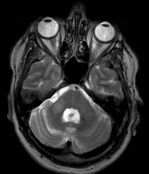 Väikeaju sarkoidoos MRI kujutis: lesioon paremal pedunculus
