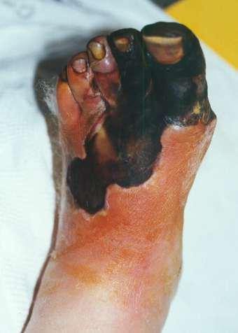 gangrene