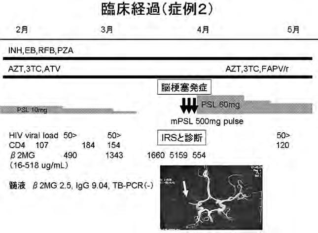 The Journal of AIDS Research Vol. 3 No.,,**1 CD. ml HIV-RNA -0 +3 34,+* / TB ART IRS ART mpsl -. 0* 140+* / MAC ART 0, TB,1 +/.