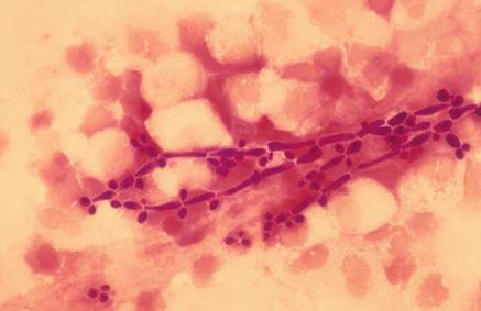patologija. Kandidozė nepriskiriama lytiškai plintančių infekcijų grupei. Dažytame tiriamosios medžiagos tepinėlyje radus grybelio pseudomicelį galima įtarti Candidaspp. (8 pav.). 8 pav.