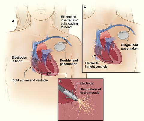 Taupada markagailua National Heart Lung and Blood Institute irudia CC lizentziarekin Pixabayen