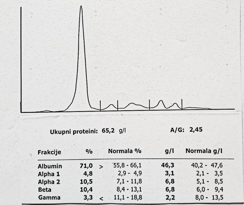 Hipogamaglobulinemija IgG 1.92 g/l IgA < 0.58 g/l IgM <0.046 g/l Slobodni laki lanci kapa 8.21 mg/l Slobdni laki lanci lambda 0.