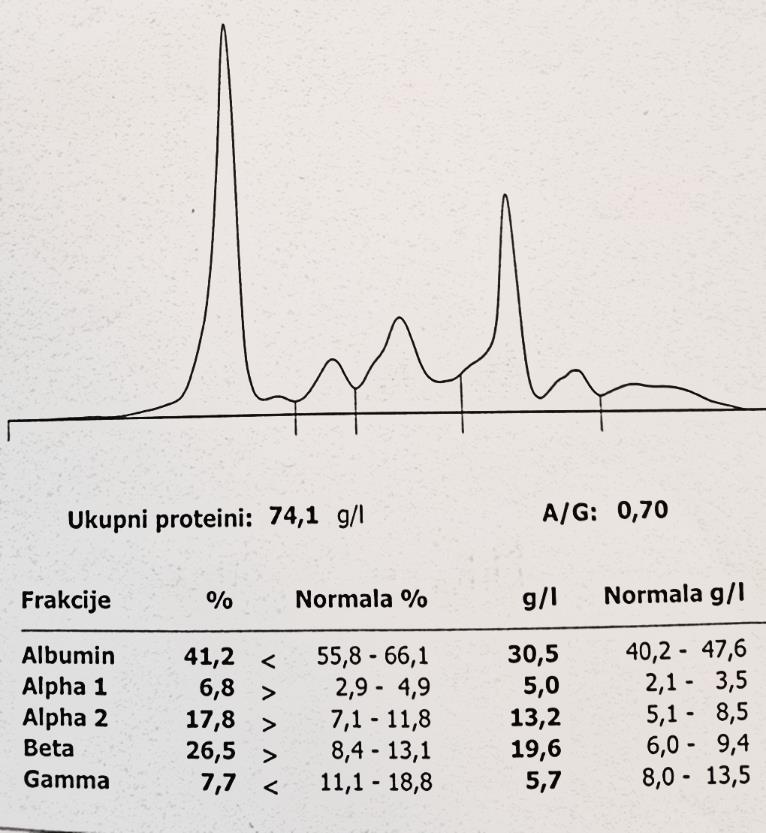 Bolest lakih lanaca IgG 5.64 g/l IgA 0.13 g/l IgM 0.