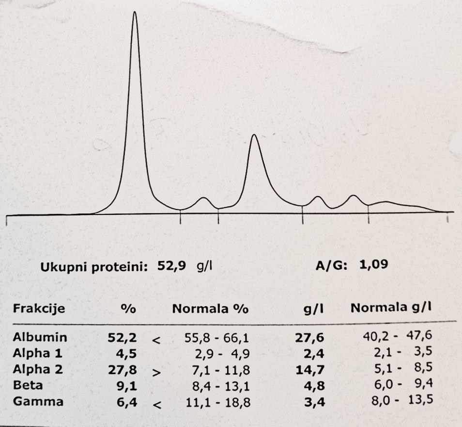Nefrotski sindrom Izrazito povišena α2 frakcija te smanjena albuminska i Ƴ globulinska frakcija ukazuju na renalni gubitak proteina.